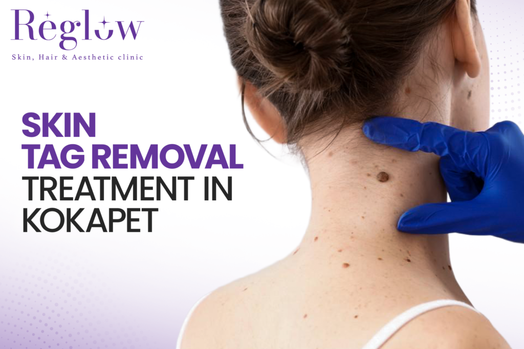 Best Skin Tag Removal Treatment in Kokapet