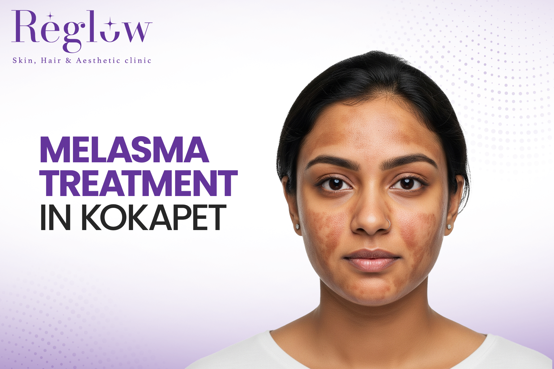 Melasma Treatment in Kokapet – Reglow Skin, Hair & Aesthetic Clinic