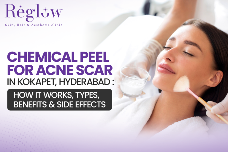 Chemical Peel for Acne Scar in Kokapet, Hyderabad: How It Works, Types, Benefits & Side Effects