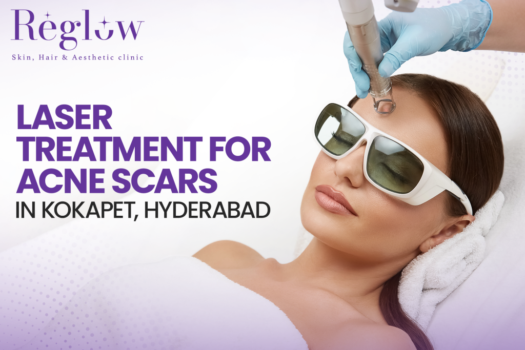 Laser Treatment for Acne Scars in Kokapet