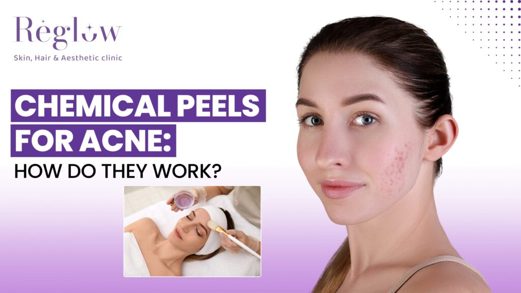 chemical peels for acne in Kokapet