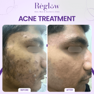 01 - REGLOW - BEFORE AFTER