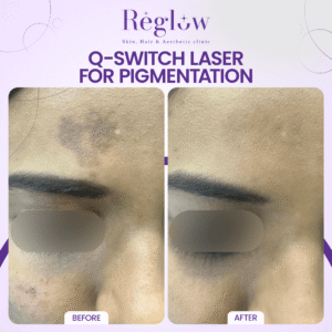 02 - REGLOW - BEFORE AFTER