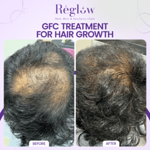 03 - REGLOW - BEFORE AFTER