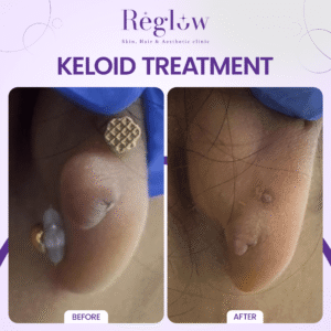 04 - REGLOW - BEFORE AFTER