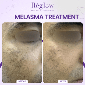 05 - REGLOW - BEFORE AFTER