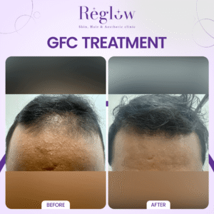 06 - REGLOW - BEFORE AFTER