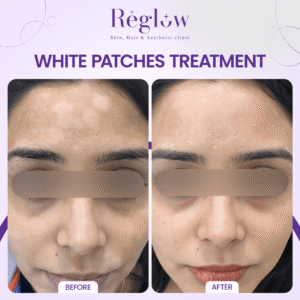 07 - REGLOW - BEFORE AFTER