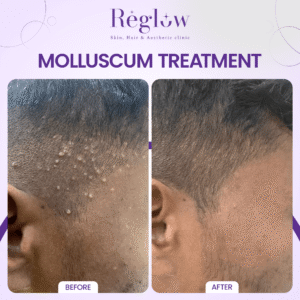 08 - REGLOW - BEFORE AFTER