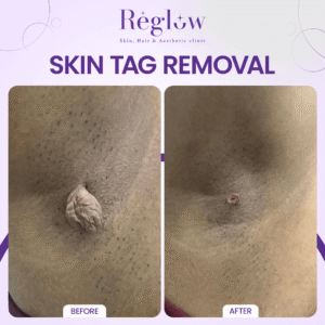 09 - REGLOW - BEFORE AFTER