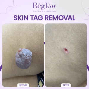 10 - REGLOW - BEFORE AFTER