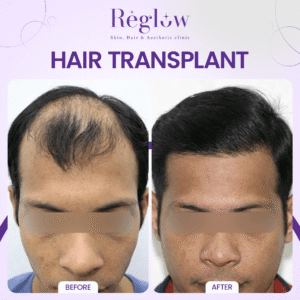 11 - REGLOW - BEFORE AFTER