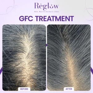 12 - REGLOW - BEFORE AFTER